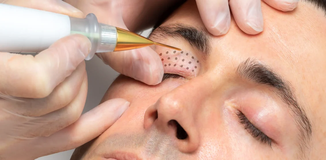 male client receiving plasma fibroblast treatment on eyes