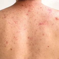 male client with back acne who will benefit from led light therapy treatment