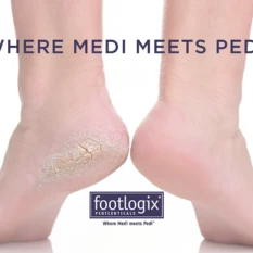 Footlogix pediceuticals image of extremely dry heels of pedicure client.